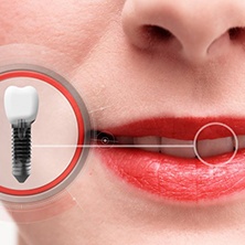 close-up of a person with a dental implant