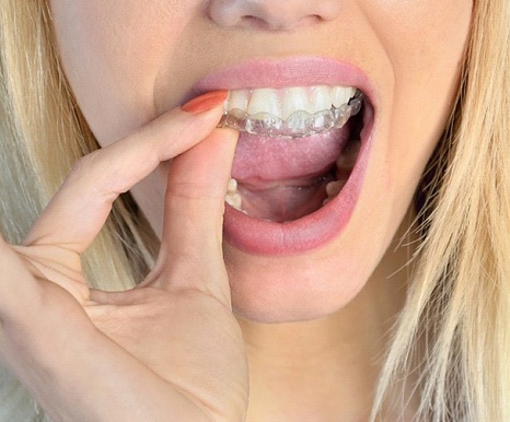 woman removing tray for Invisalign in Spring