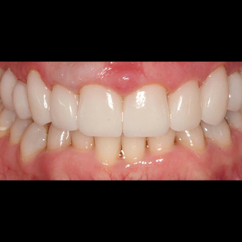 Healthy aligned smile after dental treatment