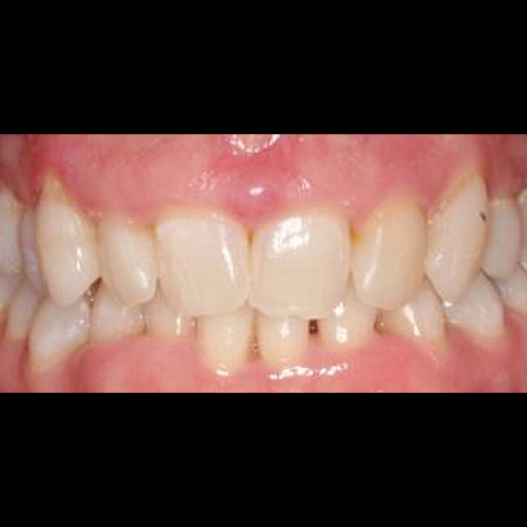 Misaligned smile before dental treatment