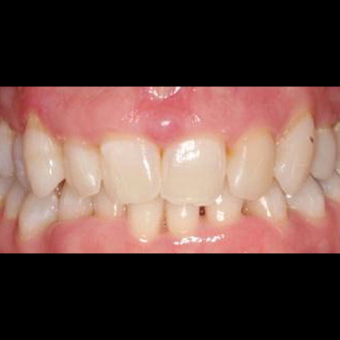 Misaligned smile before dental treatment