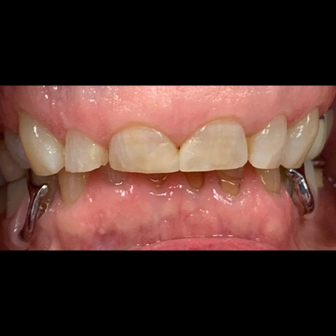 Stubby damaged teeth before dental treatment