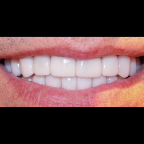 Gap between top front two teeth closed