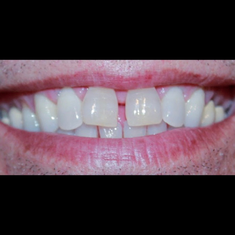 Gap between top front two teeth