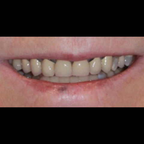 Discolored dental restoration