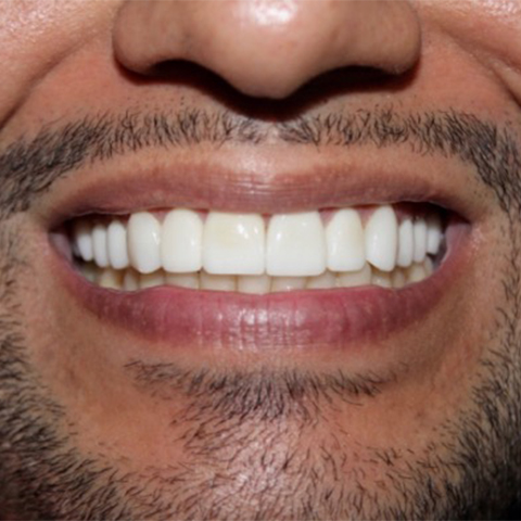 Brilliant smile after teeth whitening