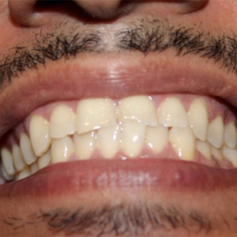 Yellow smile before teeth whitening