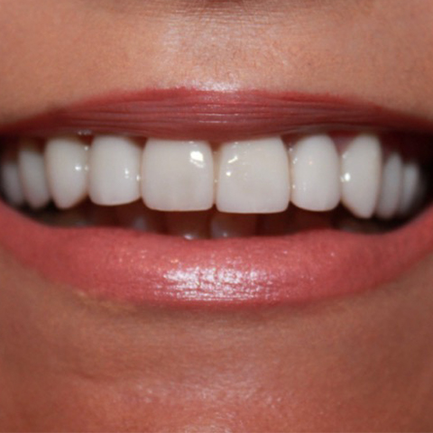 Perfected smile after dental treatment