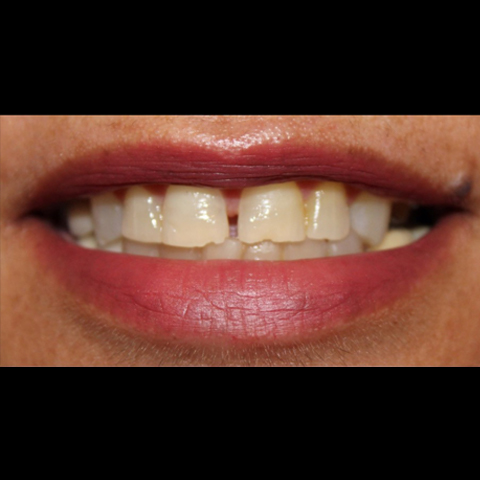 Gap between fron teeth before dental treatment