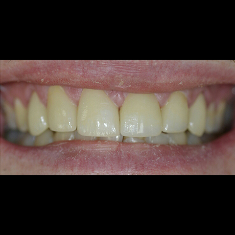 Perfectly aligned smile after dental treatment