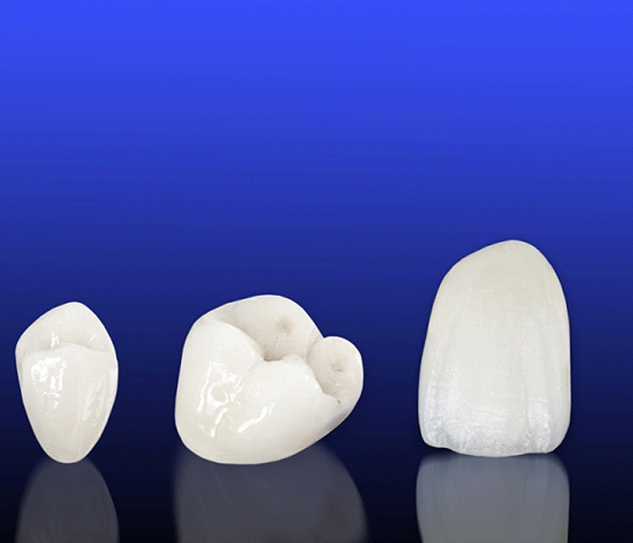 Image of all-ceramic dental crown.