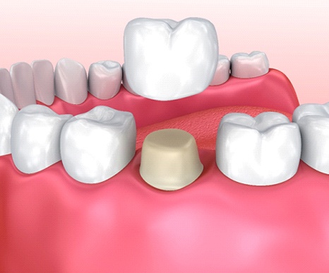 Digital model of a dental crown.