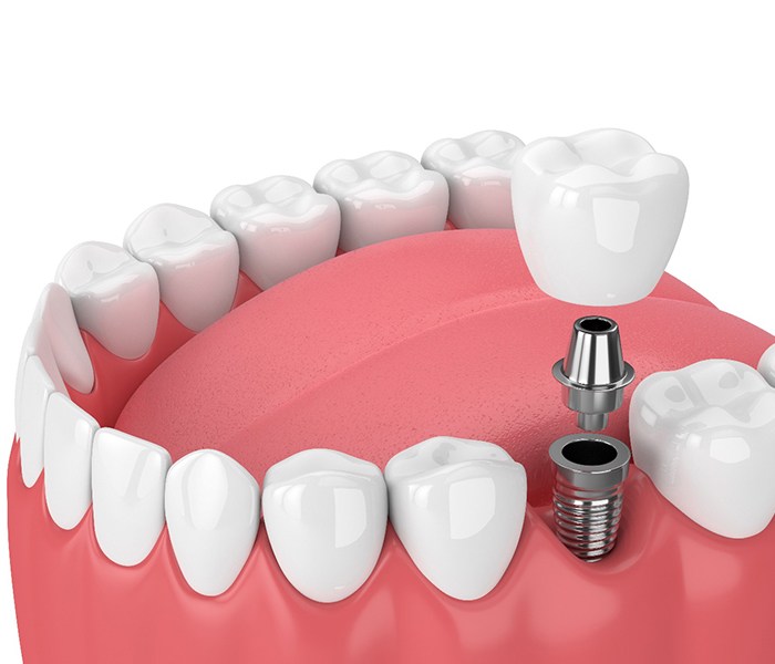 model of how dental implants in Spring work
