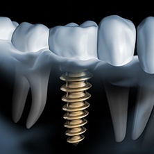 X-ray of a person with a dental implant