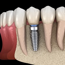 dental implant fusing to the jawbone