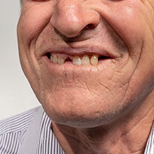 Man with missing teeth