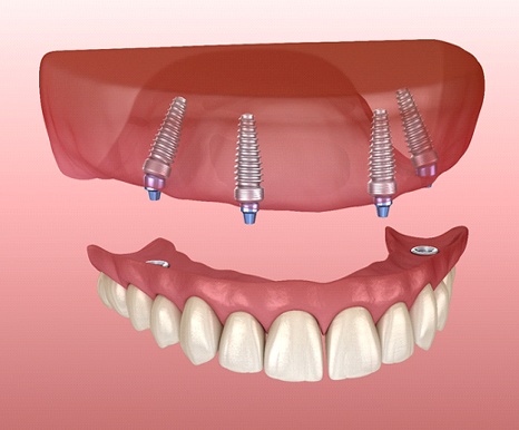 Animated implant-supported top denture