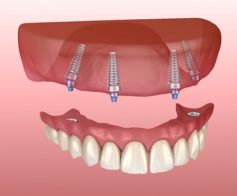 Implant-Retained Dentures Spring, TX | Missing Teeth | Spring Dentist