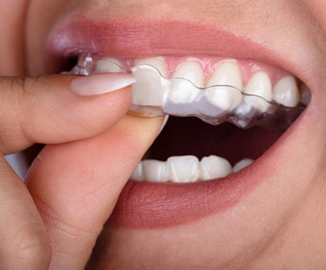 close up of person putting clear aligner in their mouth 