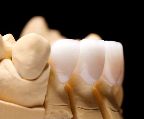 model of porcelain veneers