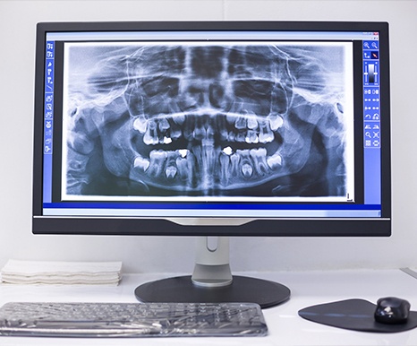 Dental x-rays on computer screen