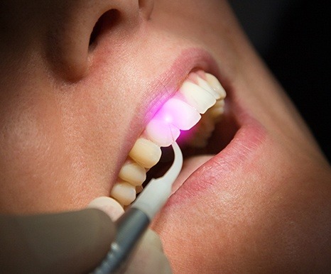 Patient receiving soft tissue laser dentistry