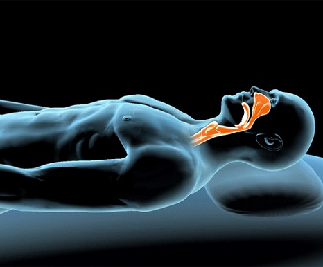 Image showing what is sleep apnea.