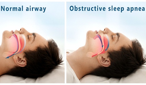 Model showing obstructive sleep apnea.