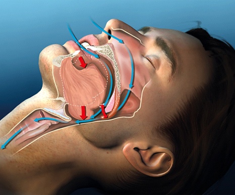 Image of a blocked upper airway.