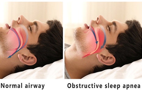 Model showing obstructive sleep apnea.