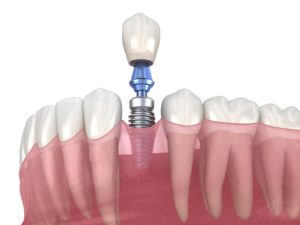 Digital model showing dental implant success.