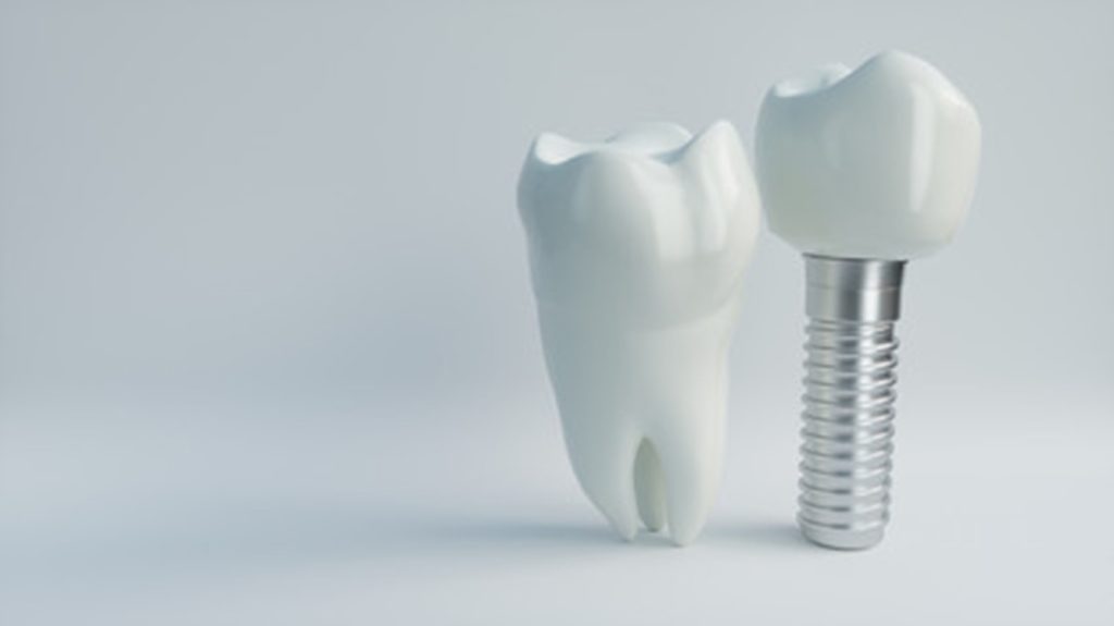 Image of dental implants. 