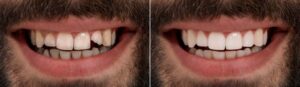before and after photo of veneers