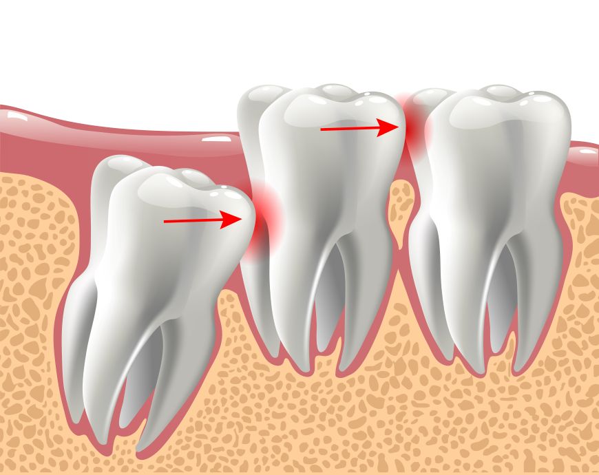 A CGI of an impacted wisdom tooth